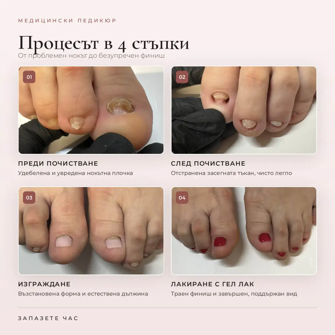 Медицински педикюр — резултат преди и след